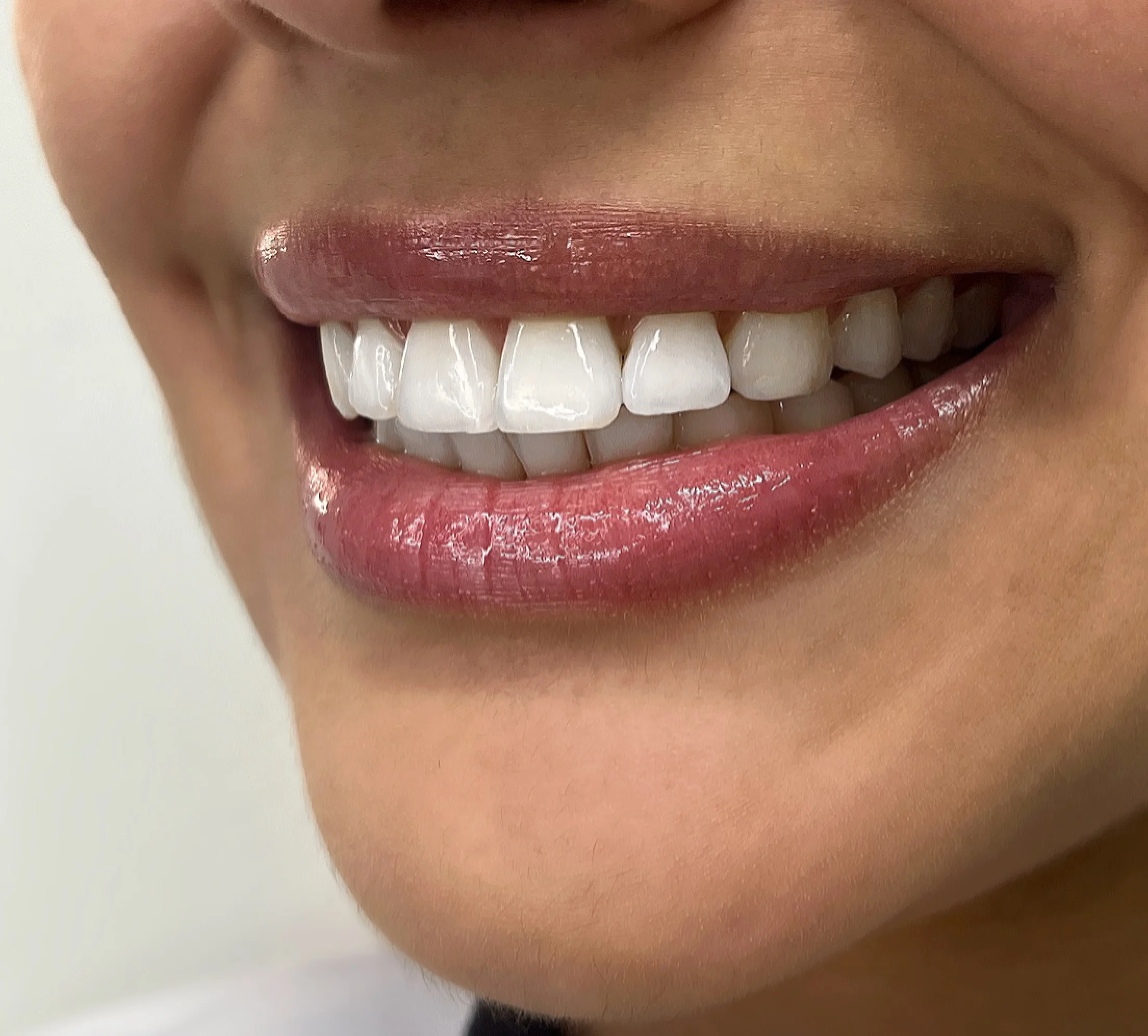 Clareamento dentário