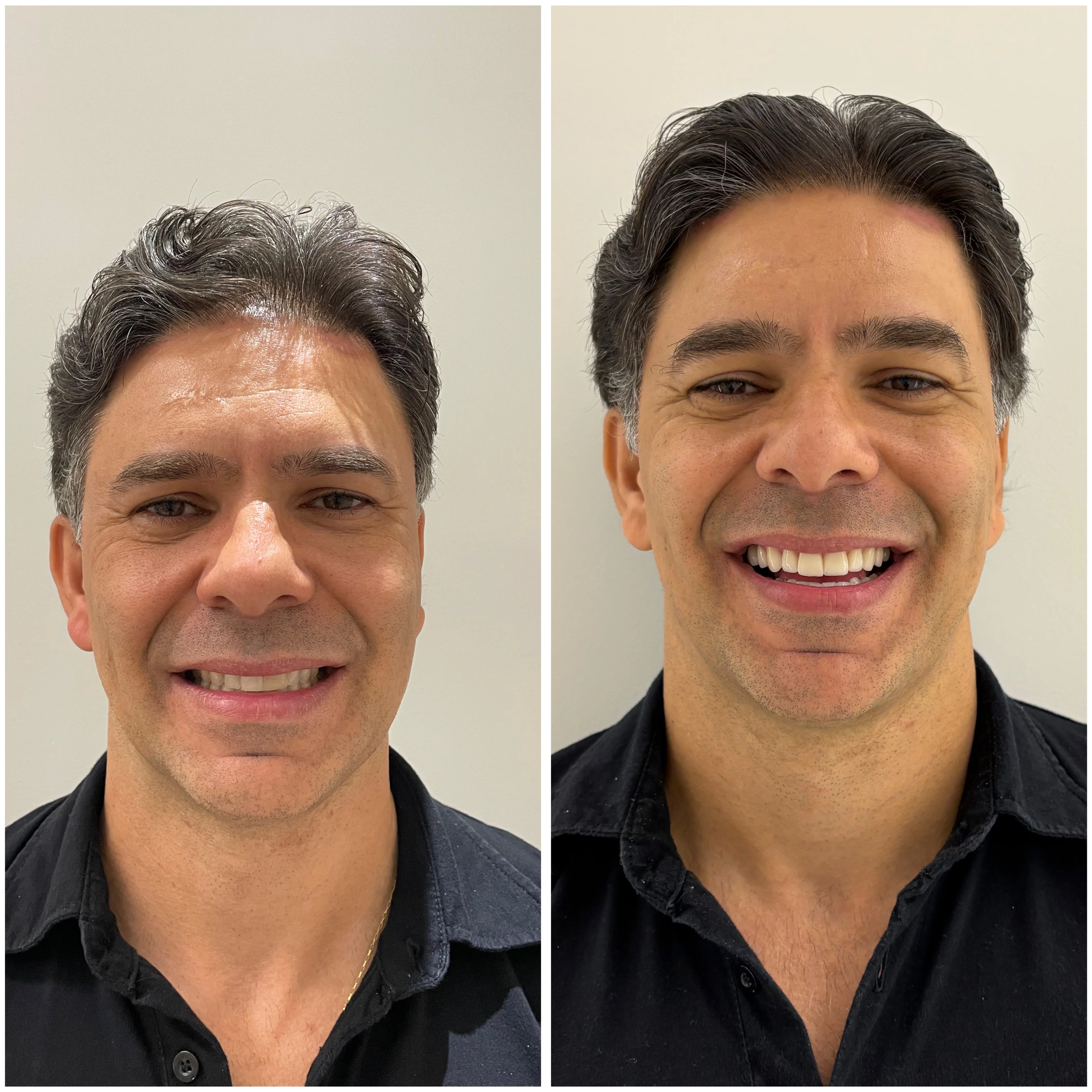 Facetas em porcelana